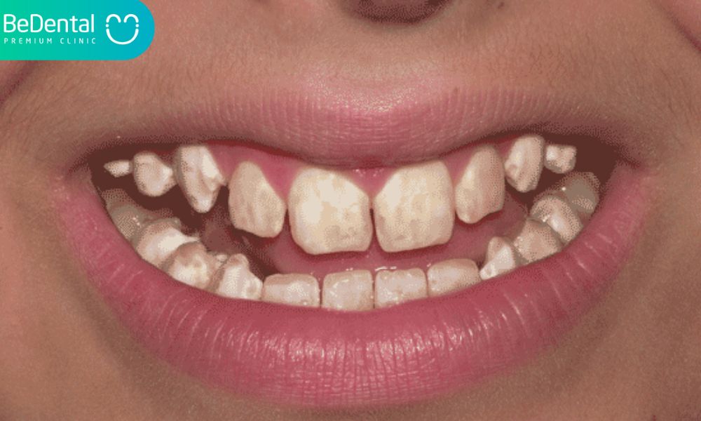 What is dental fluorosis?