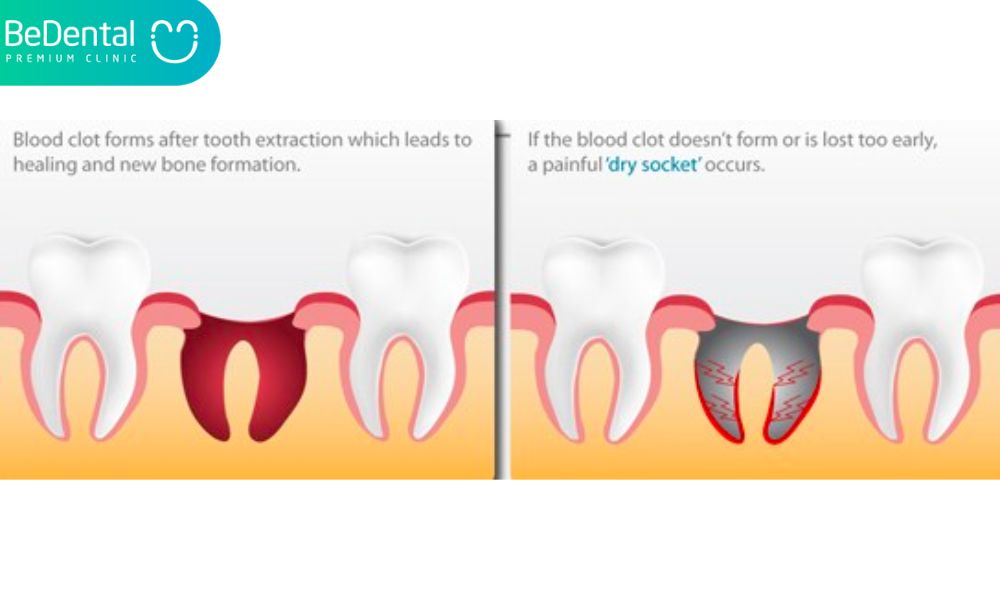 Why is wisdom tooth needed to be removed?