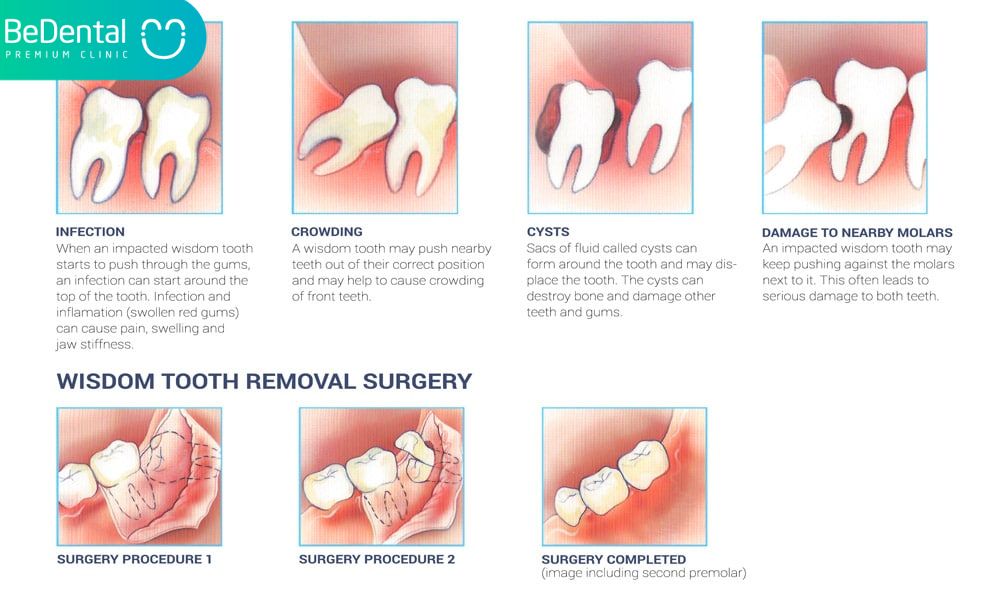 Wisdom tooth removal