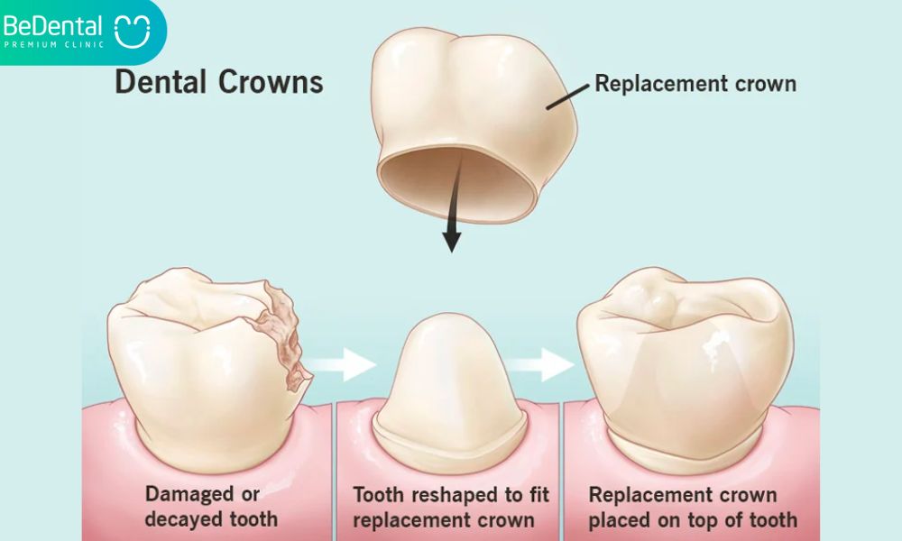 What are dental crowns?