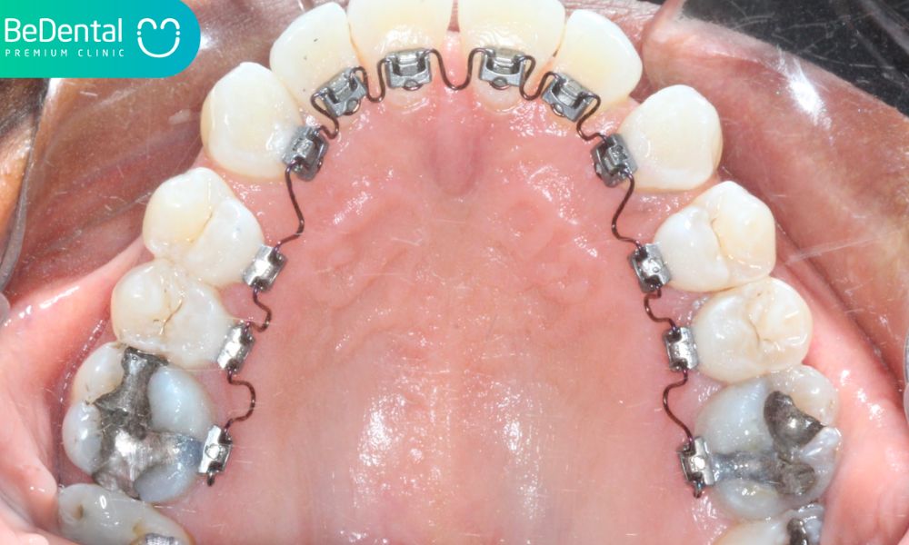 Lingual braces