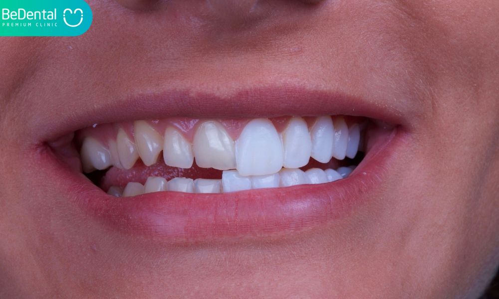 Cost of zirconia crowns/veneers