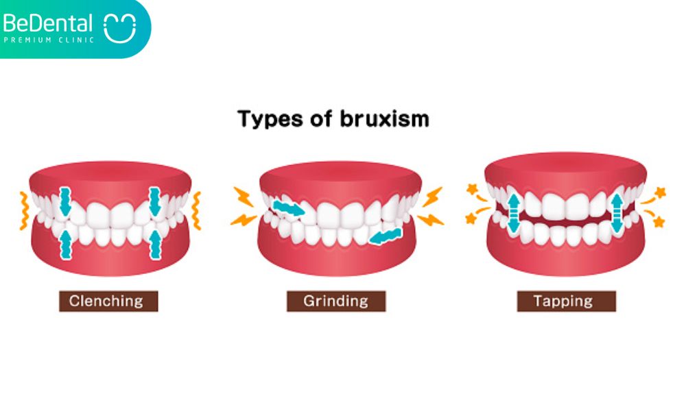 What causes teeth grinding?