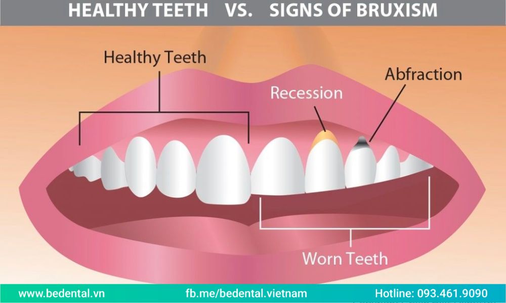 What is teeth grinding?