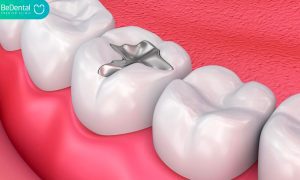 Dental Filling vs Crown