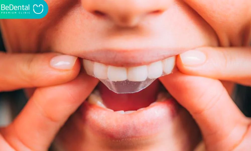 Over-the-counter teeth whitening 