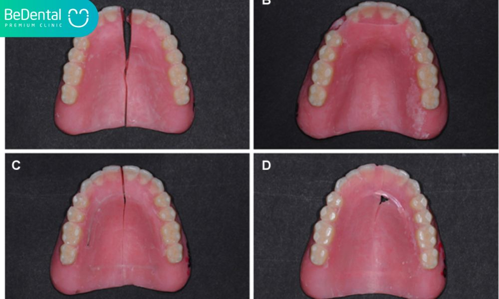 The defaults of denture base