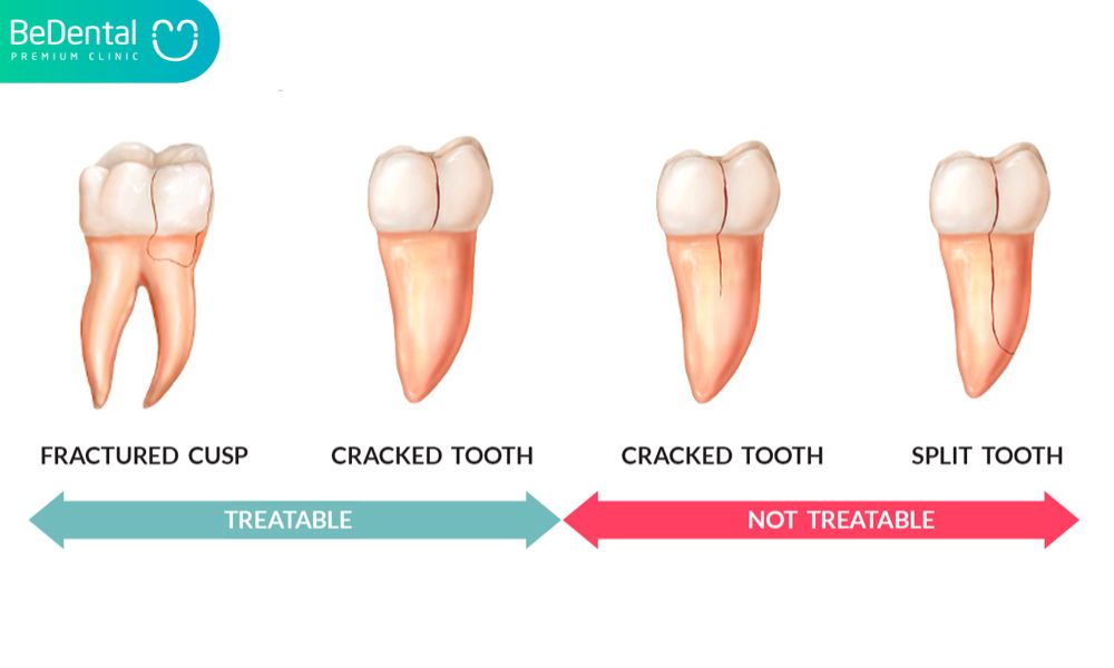 types of cracked tooth