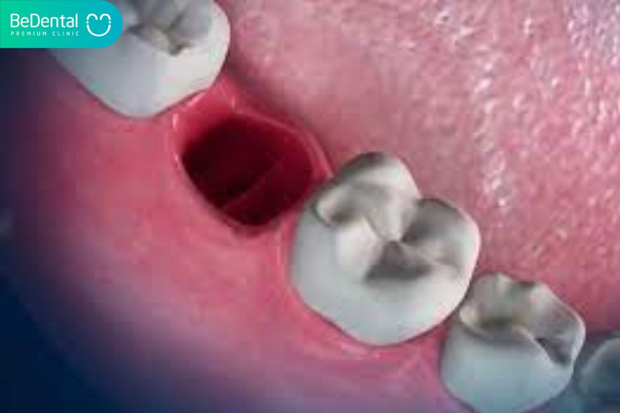 Chỉ còn chân răng khi răng hàm bị sâu xử lí như thế nào ?