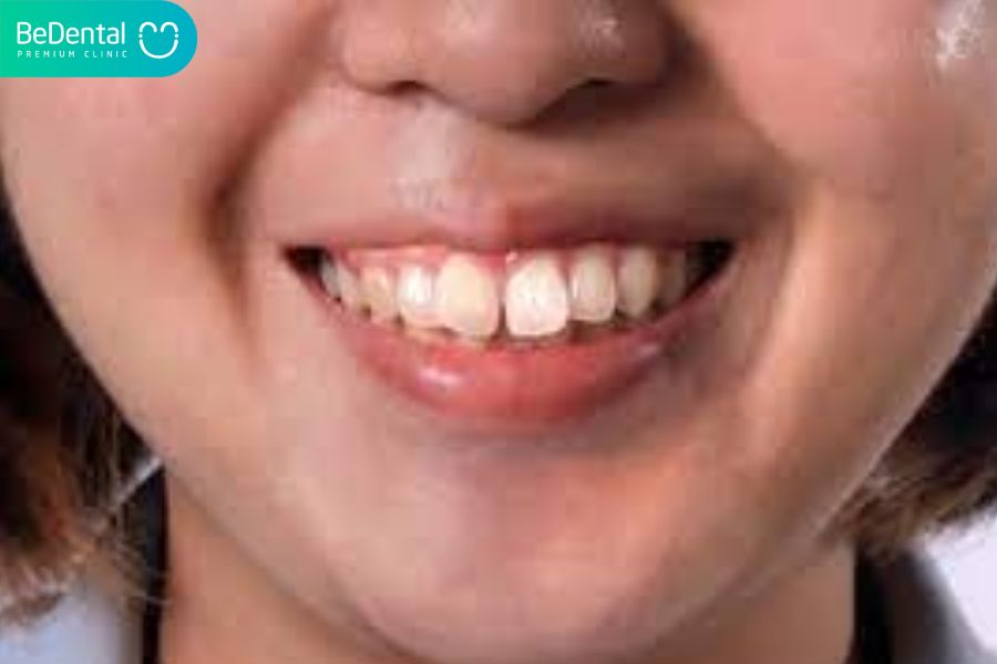 Thời gian niềng răng cũng phụ thuộc vào loại răng