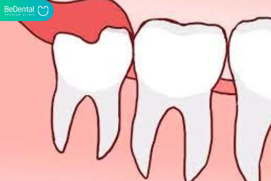 Nhổ răng khôn mọc thẳng liệu có đau?