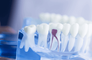 Trường hợp nào cần thiết chữa tuỷ răng