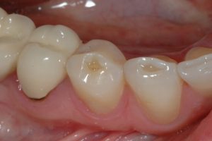 guyên nhân dẫn đến tình trạng mòn men răng