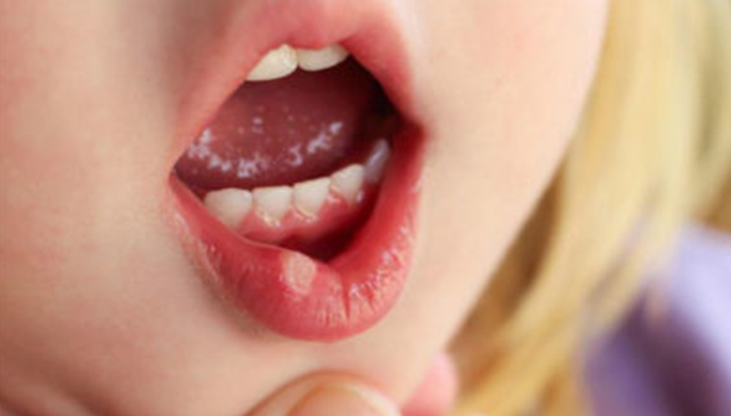 Phòng ngừa ngậm môi dưới cho trẻ