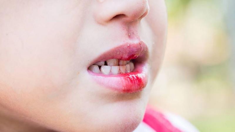 Prevention of children Sucking the lower lip