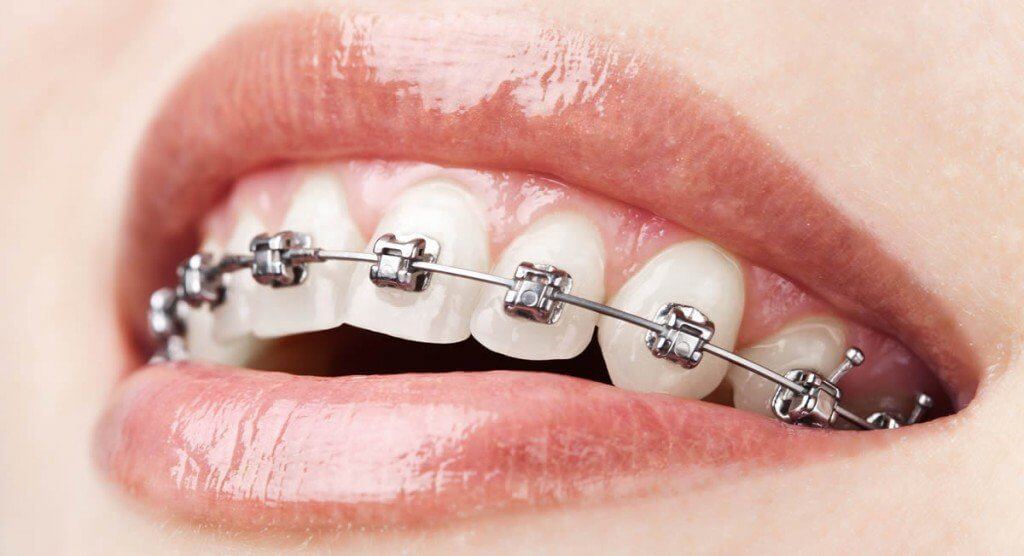 Braces for underbite in Vietnam