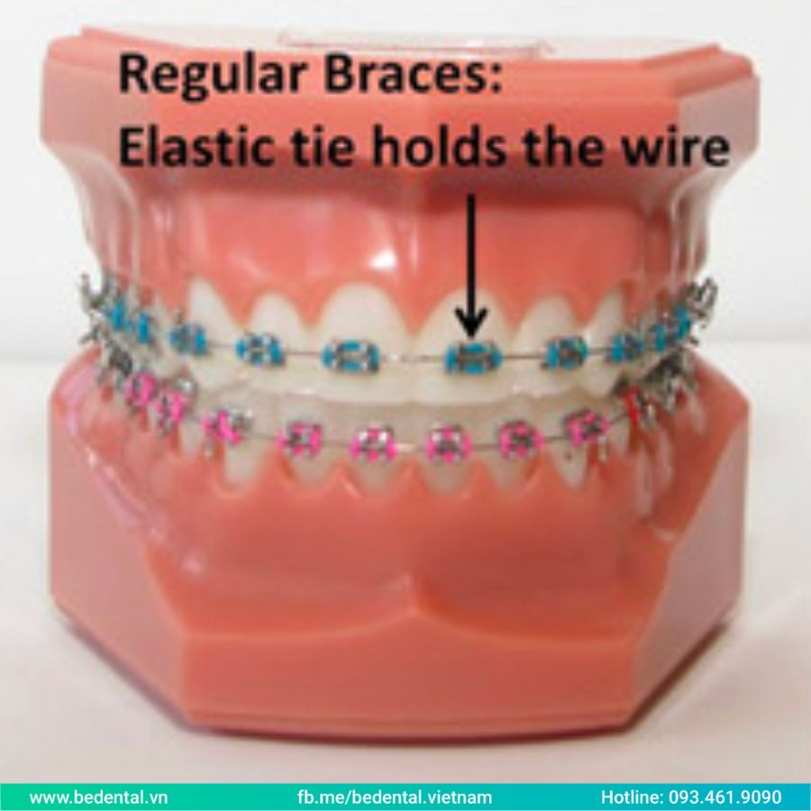 vuông bedental 14