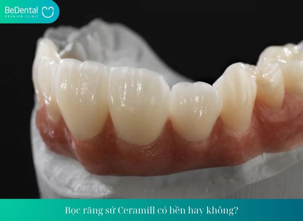 Bọc răng sứ Ceramill có bền hay không?