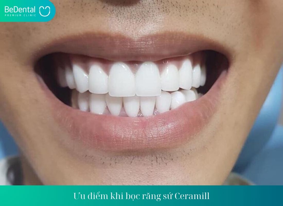 Ưu điểm khi bọc răng sứ Ceramill