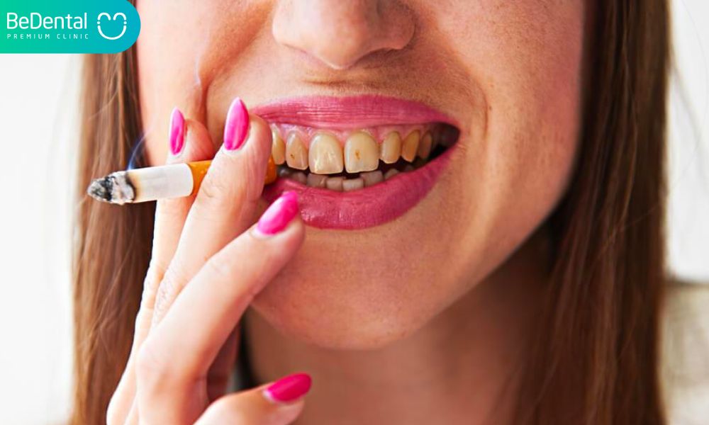 Bệnh lý răng miệng thường gặp khi hút thuốc lá