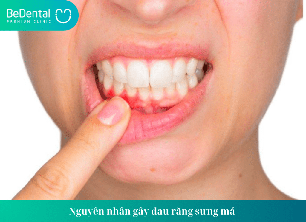 Viêm nướu là nguyên nhân khiến đau răng sưng má