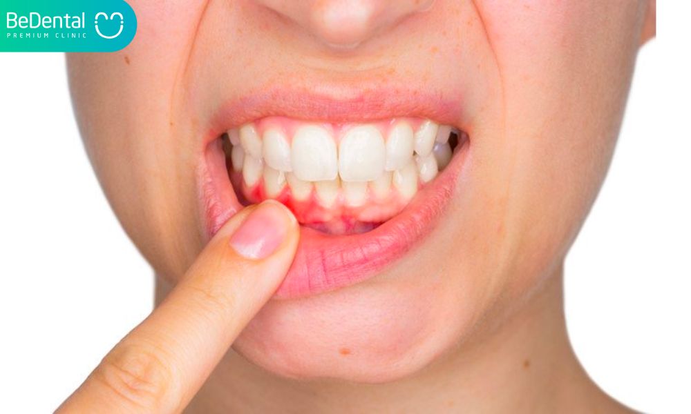 Viêm nướu là nguyên nhân khiến đau răng sưng má