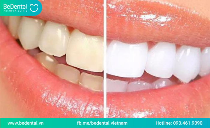 Bọc răng sứ có cạo vôi răng không-Trường hợp nào nên bọc răng sứ