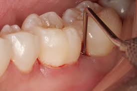 Răng khôn mọc trong cùng hàm, khi các răng khác đã mọc hết, vì vậy nó thường không đủ chỗ, dễ dẫn tới mọc lệch, đâm vào răng bên cạnh.