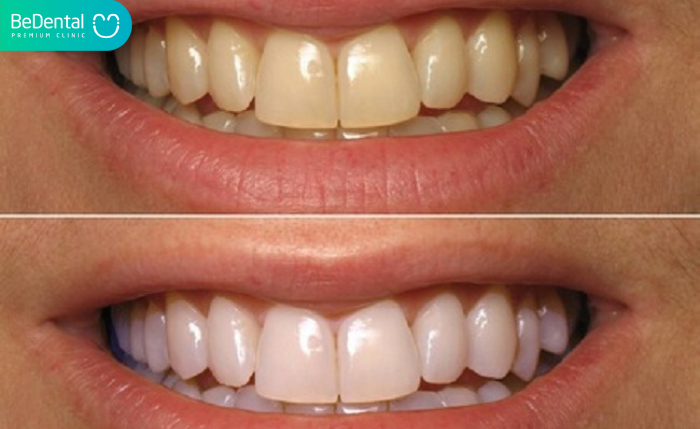 Cao răng vàng là gì-Sau khi lấy cao răng vàng cần làm gì