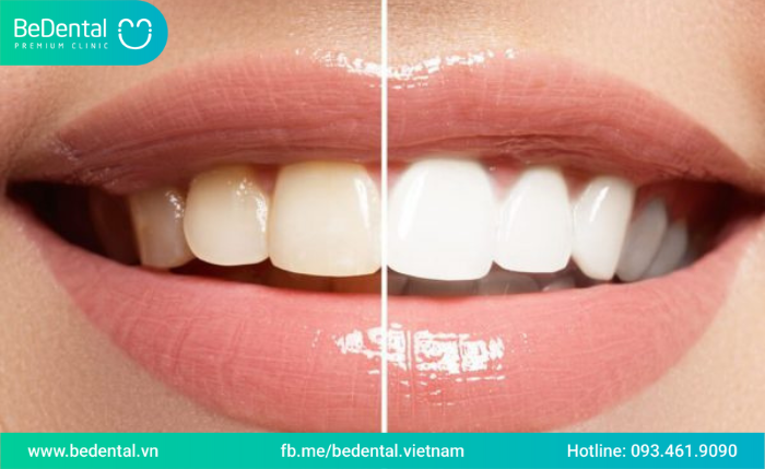 Bao nhiêu tuổi thì tẩy trắng răng được-Tẩy trắng răng nhiều lần có sao không?