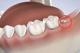 Răng khôn mọc lệch ảnh hưởng tới sức khỏe răng miệng thì sẽ được bác sĩ chỉ định nhổ bỏ.