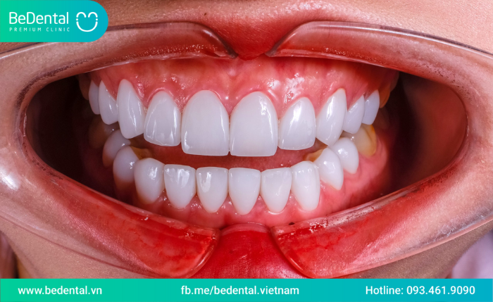 Bao nhiêu tuổi thì tẩy trắng răng được-Tẩy trắng răng nhiều lần có sao không?