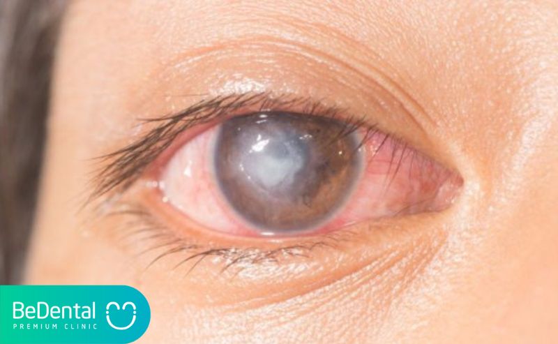 viêm loét giác mạc là 1 trong các bệnh về mắt