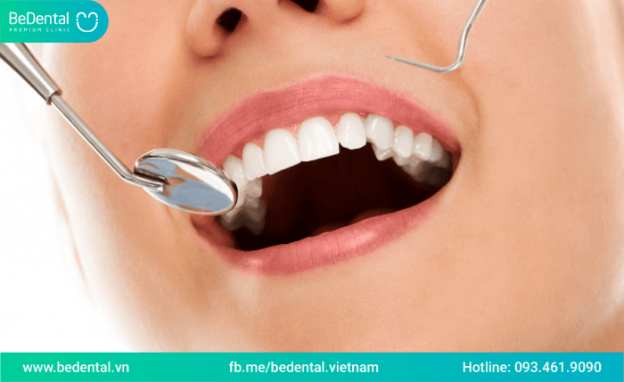 Nguyên nhân răng bị thưa sau khi niềng răng? Cách khắc phục tình trạng răng thưa sau niềng