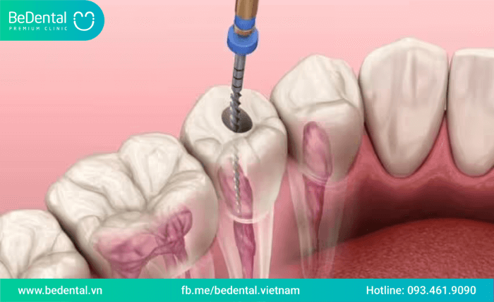 Lấy tủy răng có ảnh hưởng đến răng vĩnh viễn không?