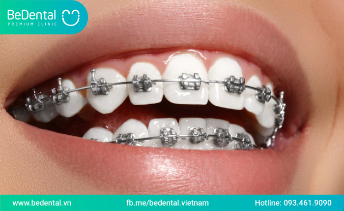 Niềng răng 1 hàm có được không -Các trường hợp chỉ định niềng răng một hàm