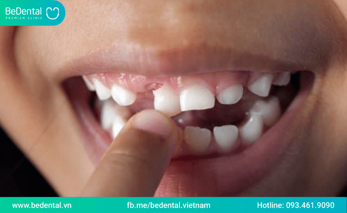 Nhổ răng sữa có mọc lại không? Nhổ răng sữa bao lâu mọc lại?