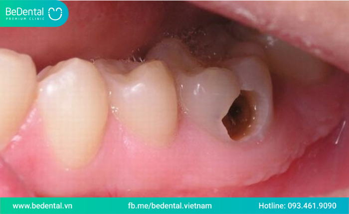 Sâu răng khôn là gì ?Dấu hiệu cho thấy sâu răng khôn