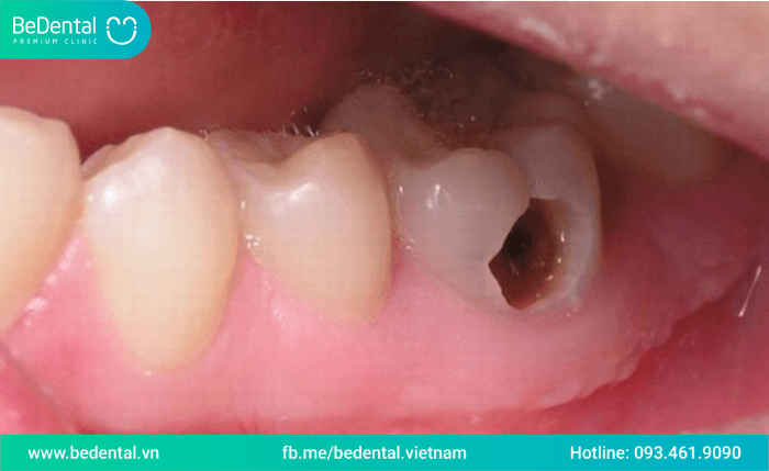 Tại sao sâu răng lại đau nhức?