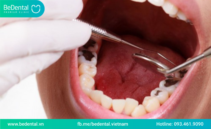 Răng chữa tuỷ tồn tại được bao lâu?Cách chăm sóc và bảo vệ răng sau khi chữa tuỷ 