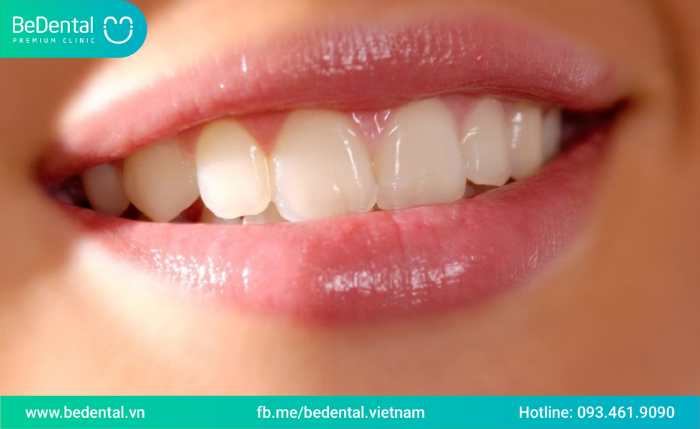 Hàn răng sâu có được lâu hay không-Vì sao lại phải hàn răng