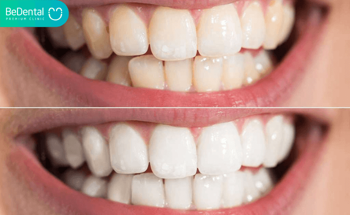 Quy trình tẩy trắng răng tại phòng khám ? Tại sao cần thực hiện tốt quy trình tẩy trắng răng?