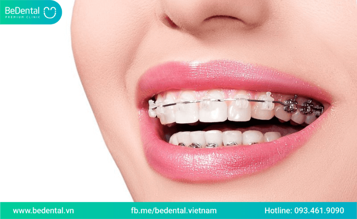 Nguyên nhân răng bị thưa sau khi niềng răng? Cách khắc phục tình trạng răng thưa sau niềng