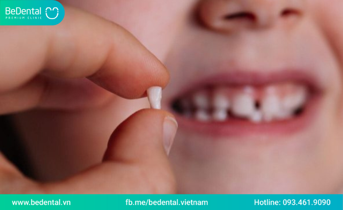 Răng sữa lung lay bao lâu thì nhổ?Nhổ răng sữa như thế nào là đúng cách