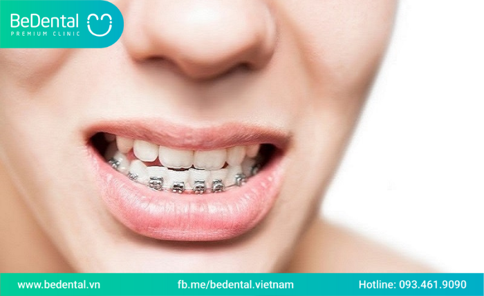 Niềng răng 1 hàm có được không -Các trường hợp chỉ định niềng răng một hàm