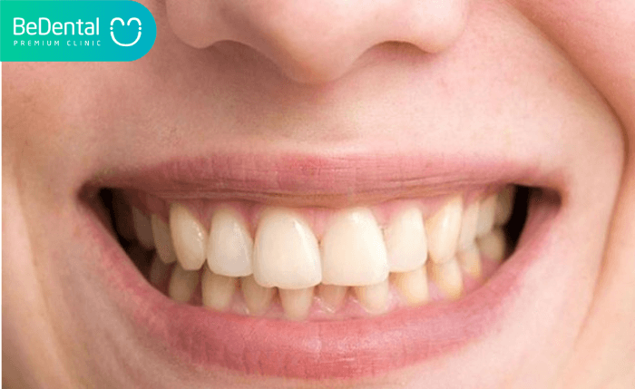Răng nhiễm fluor là gì? Răng nhiễm fluor có tẩy trắng được không?