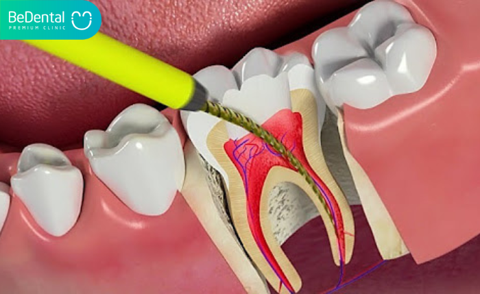 quy trình  điều trị tuỷ răng