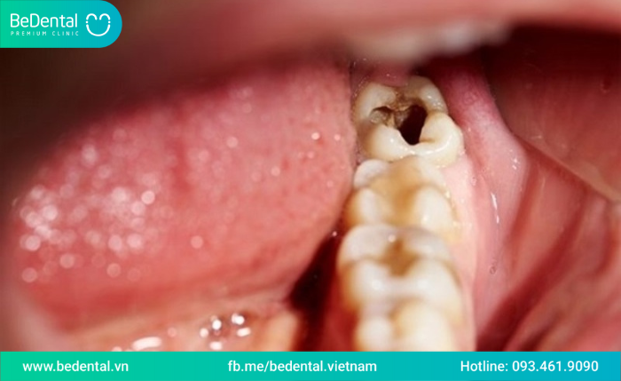 Sâu răng khôn là gì ?Dấu hiệu cho thấy sâu răng khôn