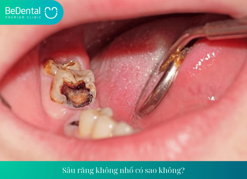 Sâu răng không nhổ có sao không?Sâu răng có nên nhổ răng không?