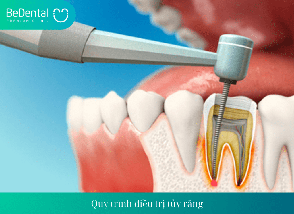 Quy trình điều trị tủy răng